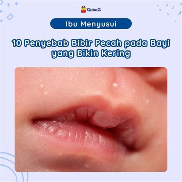 Apakah bisa bibir bayi yg pecah pecah di beri madu?