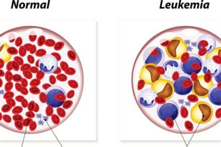 Apakah Leukemia penyakit genetik?
