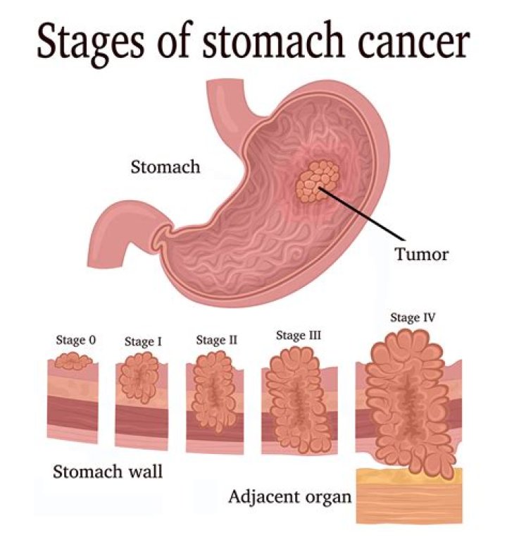 Are all gastric tumors cancerous?
