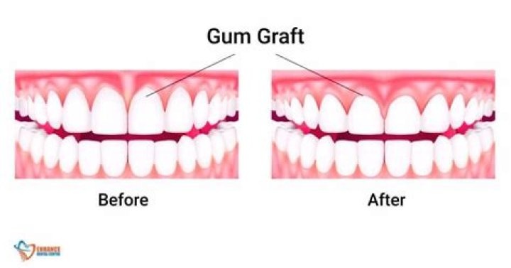 Are antibiotics necessary after gum graft?