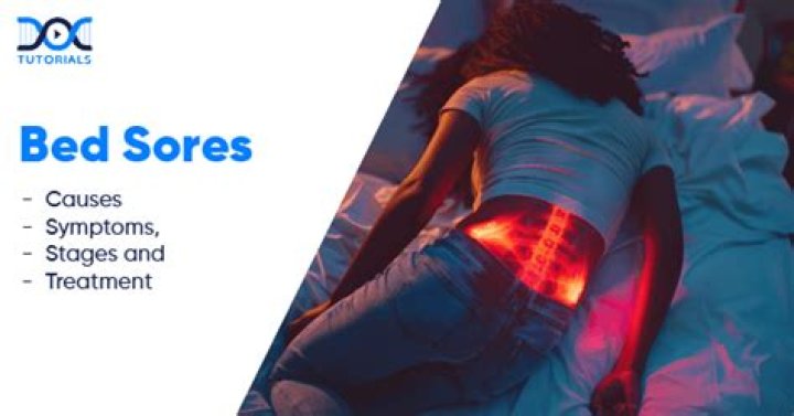 Are bed sores always a sign of neglect?