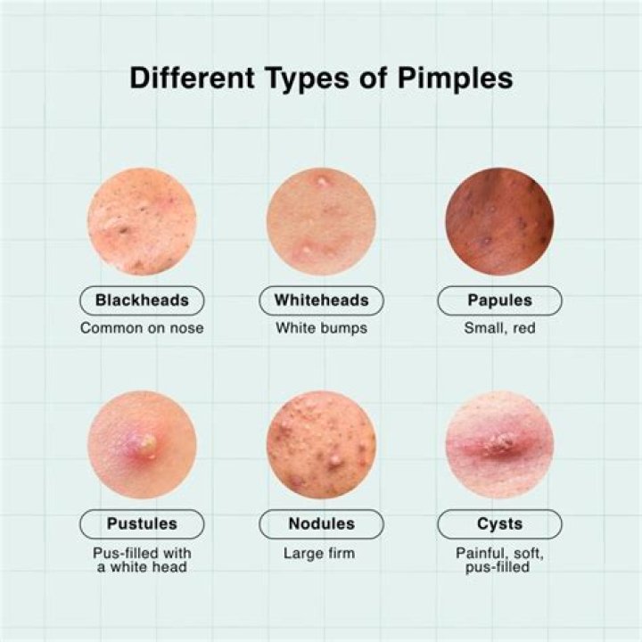 Are black pimples bad?