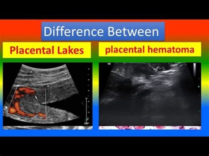Are blood Lakes real?