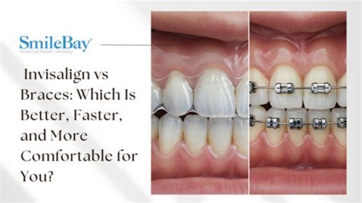 Are braces better than belts?
