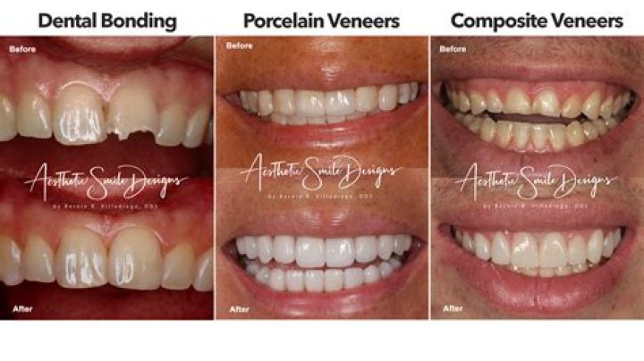Are capped teeth the same as veneers?