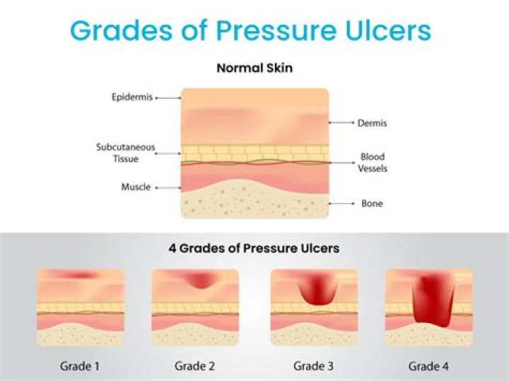 Are pressure sores reportable?