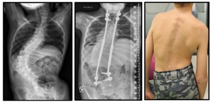 Are scoliosis rods permanent?
