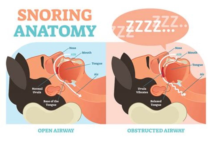 Are you snore meaning?
