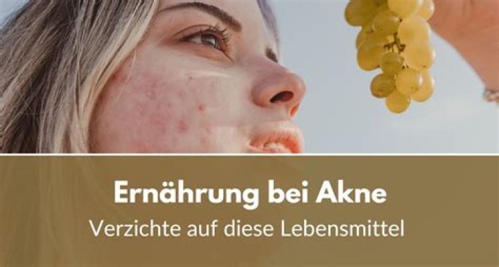 Auf welche Lebensmittel sollte man bei Akne verzichten?
