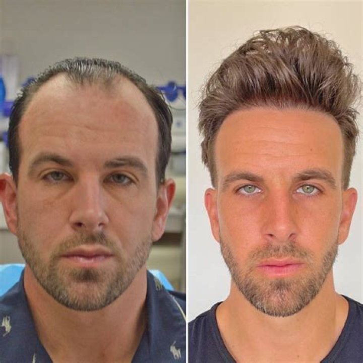 Can a 16 year old get a hair transplant?