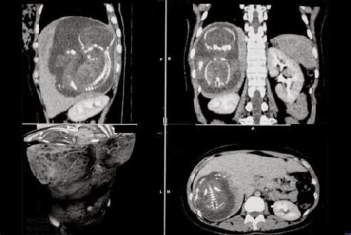 Can a baby grow on a liver?