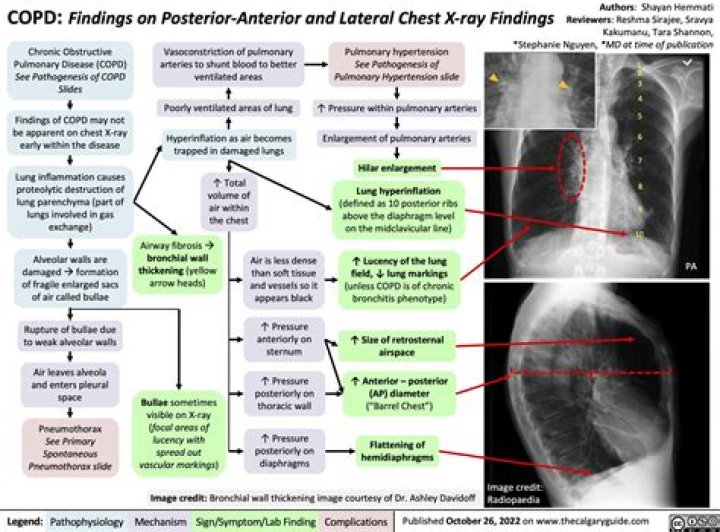 Can a chest xray show an infection?