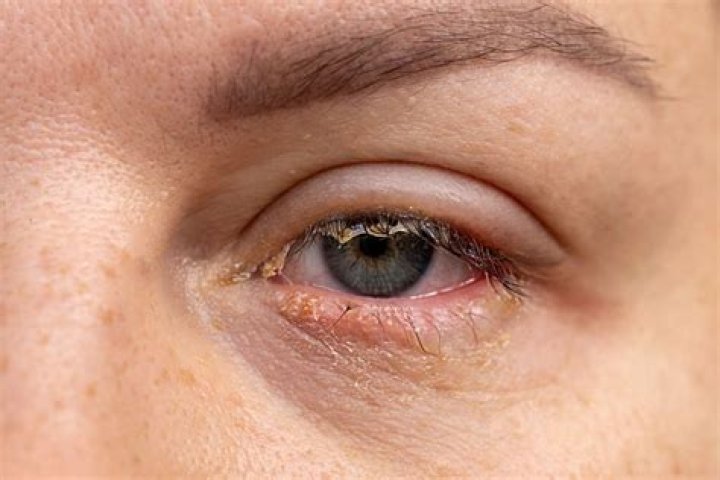Can a cold cause crusty eyes?