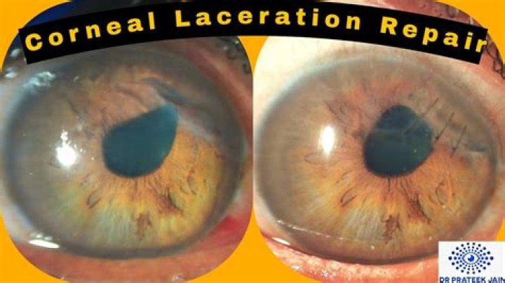 Can a cornea be repaired?