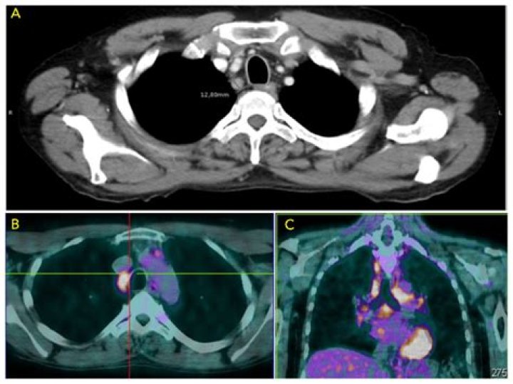 Can a CT scan miss enlarged lymph nodes?