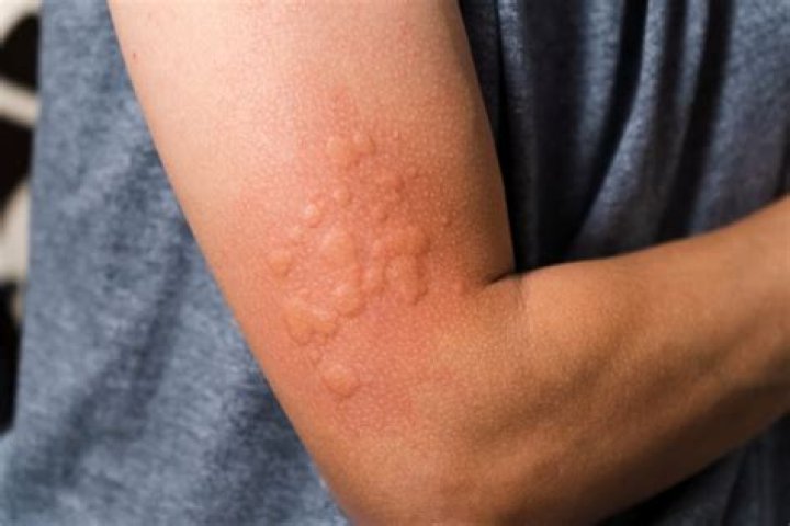 Can a person be allergic to clothes?