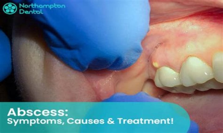 Can a popped abscess make you sick?