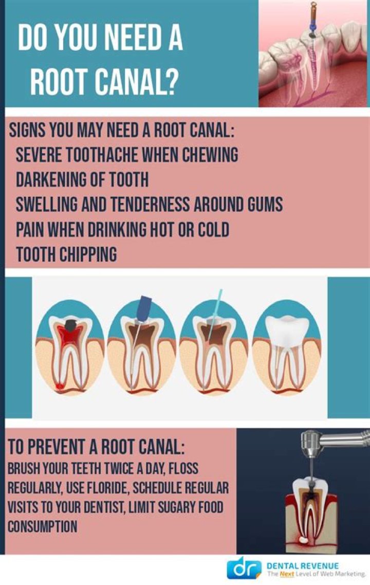 Can a small cavity need a root canal?