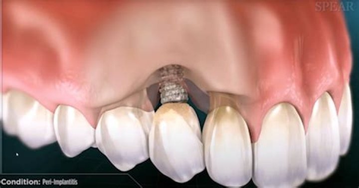 Can a tooth implant be rejected?