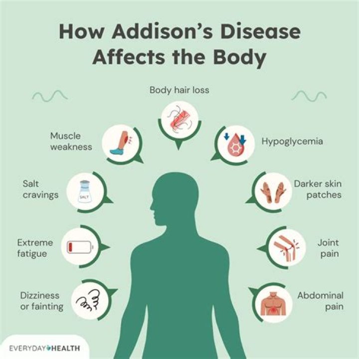 Can Addison's disease be caused by stress?