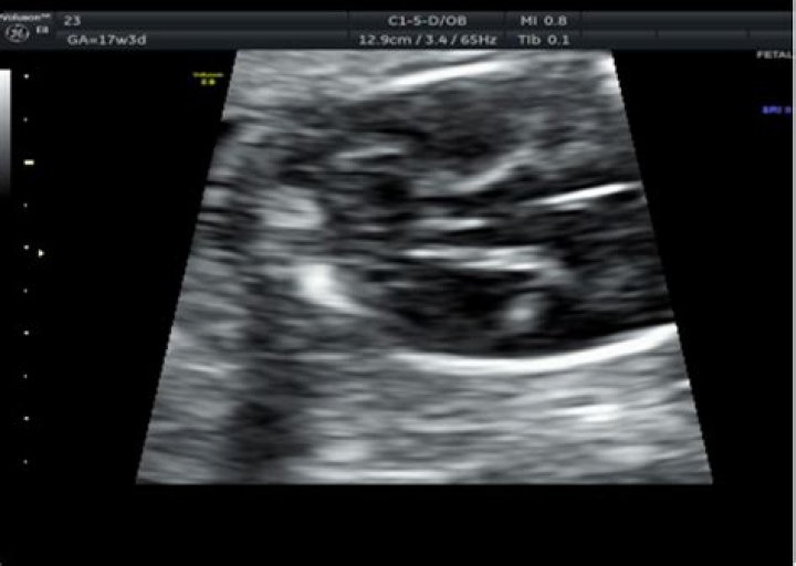 Can an anatomy scan be done at 17 weeks?