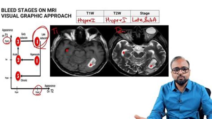 Can an MRI miss a brain bleed?