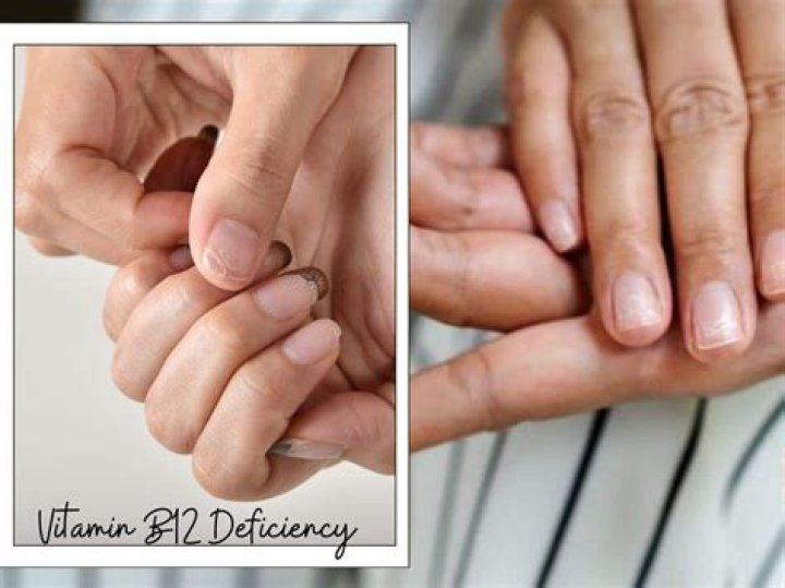 Can b12 deficiency cause nails?