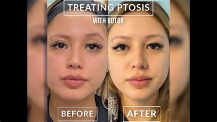 Can Botox correct ptosis?