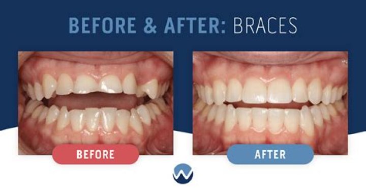 Can braces be used on veneers?
