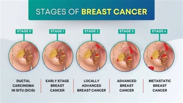 Can breast cancer be on the outside?