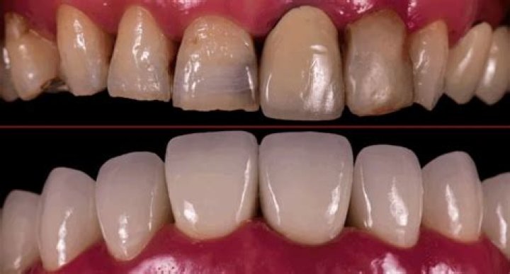 Can broken veneers be fixed?