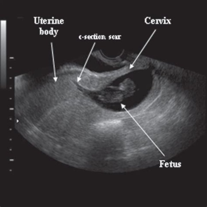 Can cervix be measured with abdominal ultrasound?