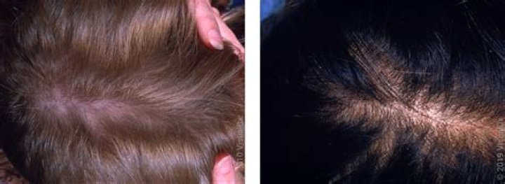 Can chronic telogen effluvium be reversed?