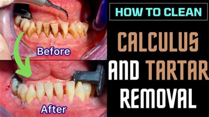 Can dentists remove calculus?