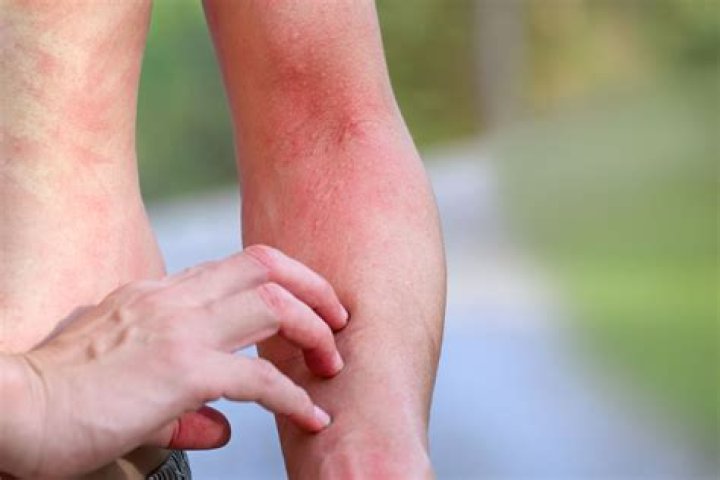 Can Diprobase cause a rash?