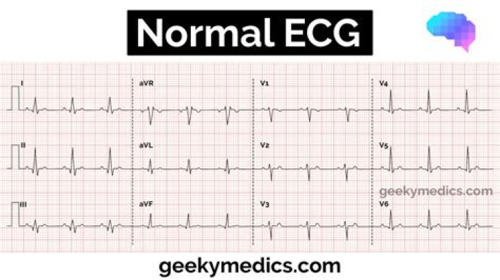Can ECG be normal in heart failure?