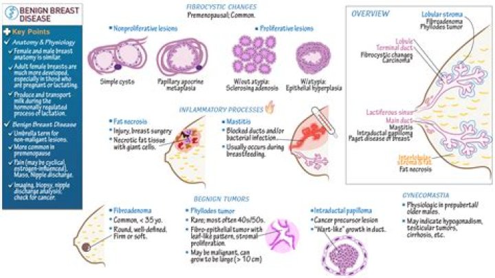 Can fat transfer to breast cause lumps?