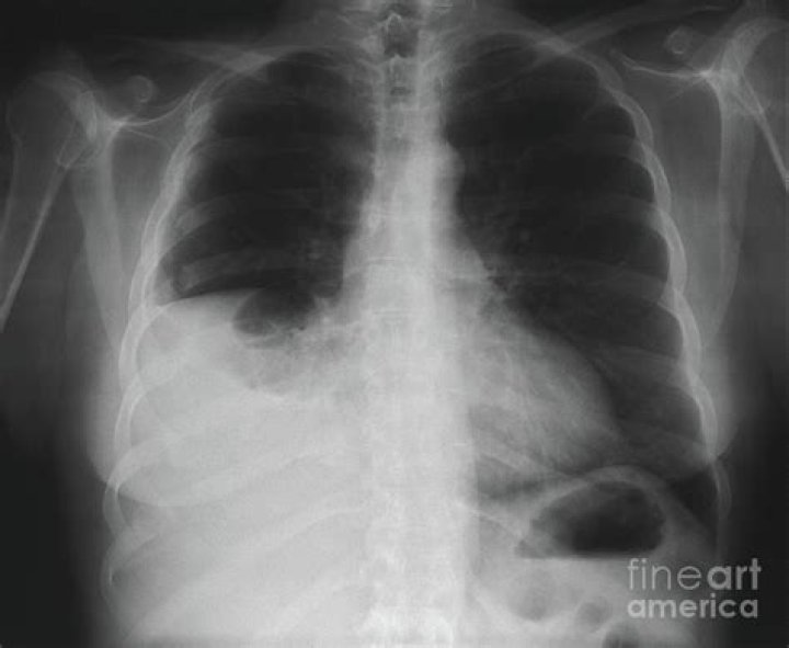 Can fractured ribs cause pleural effusion?