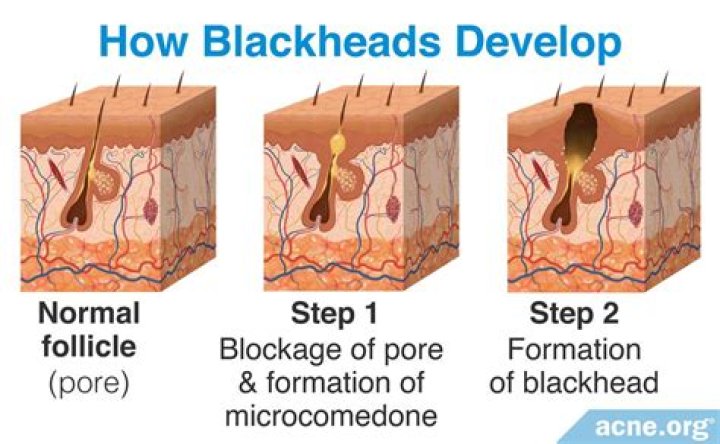 Can guys get blackheads?