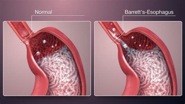 Can hiatal hernia cause Barrett's esophagus?