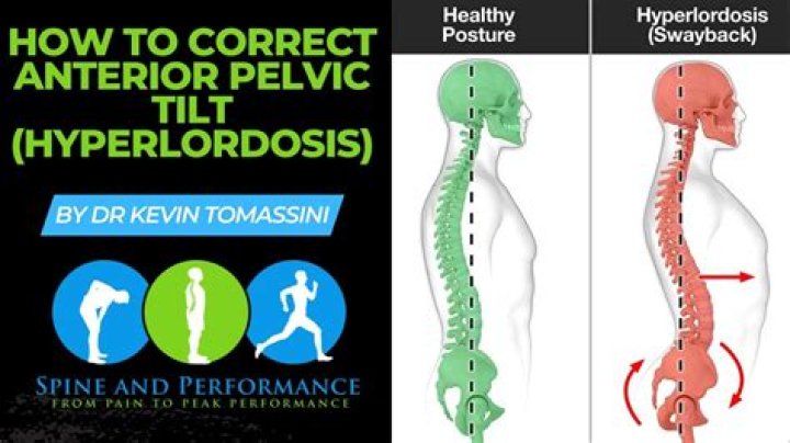Can Hyperlordosis be cured?