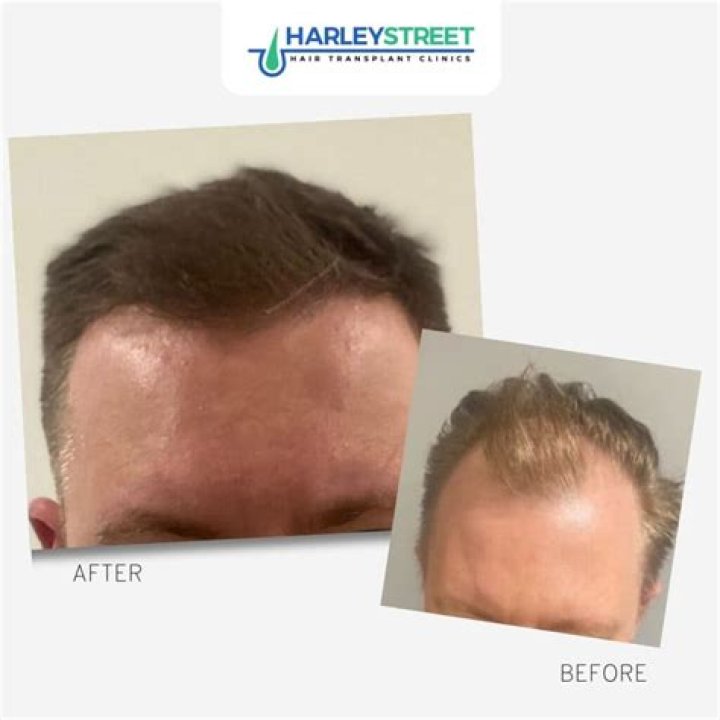 Can I finance a hair transplant?