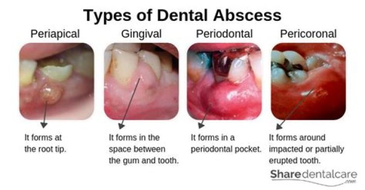 Can I pop a periodontal abscess?
