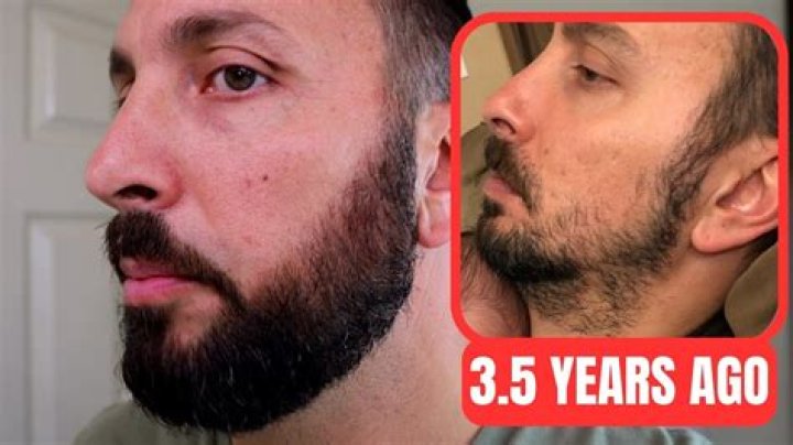 Can I use minoxidil if I already have a beard?