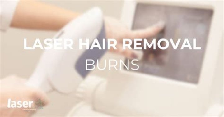 Can laser hair removal burn moles?