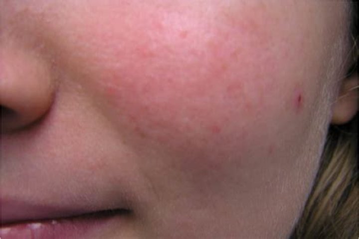 Can minocycline cause skin rash?