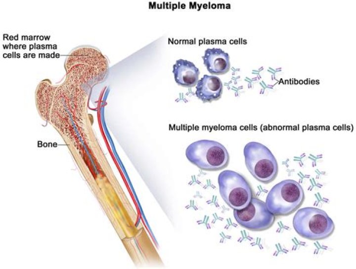 Can multiple myeloma be mistaken for arthritis?