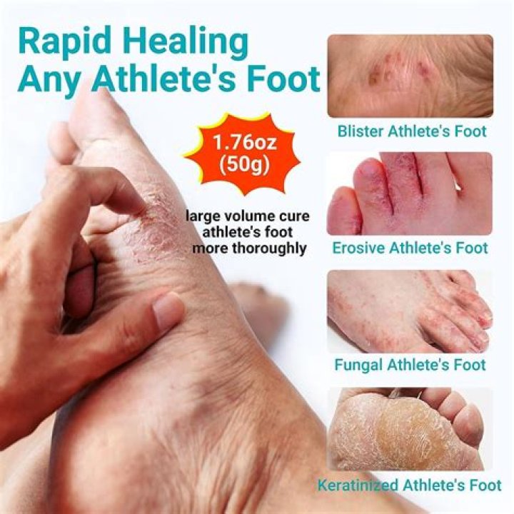Can oregano oil cure athlete's foot?