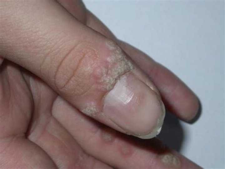 Can Periungual warts spread to mouth?