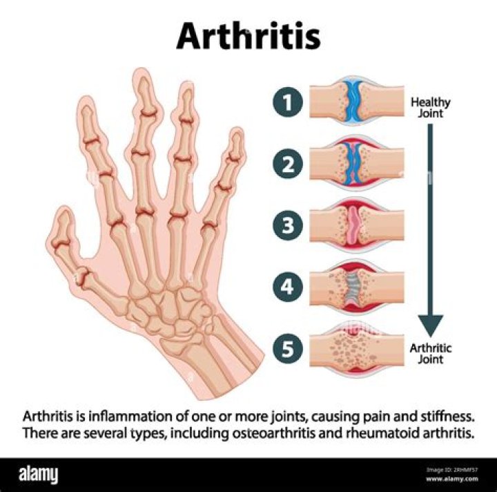 Can pianists get arthritis?